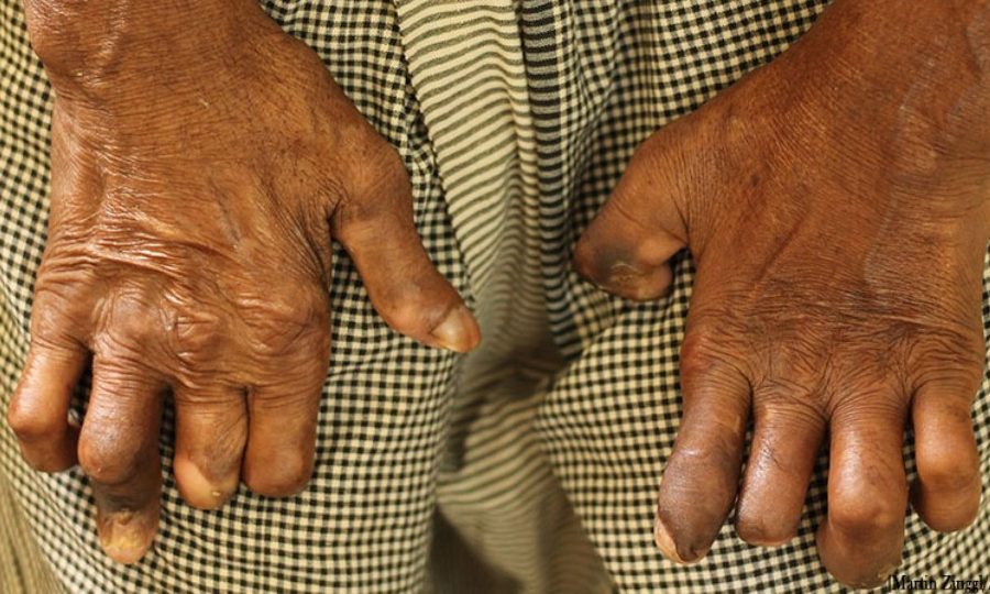 सुदूरपश्चिममा कुष्ठरोगको समस्या यथावत